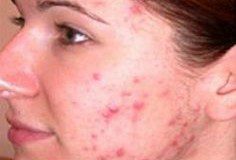 how to remove acne scars at home? Sachi Shiksha