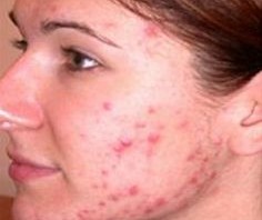 how to remove acne scars at home? Sachi Shiksha