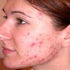 how to remove acne scars at home? Sachi Shiksha